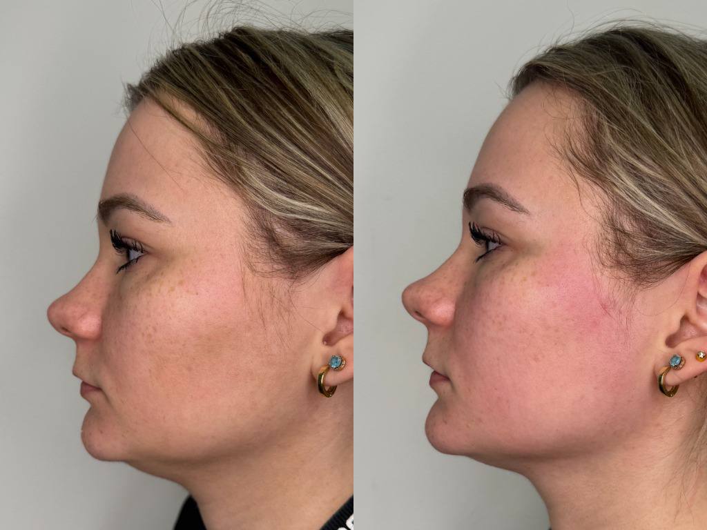 До и после Robolex: спина и ягодицы