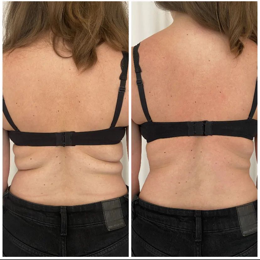 До и после Robolex: зона бюстгальтера