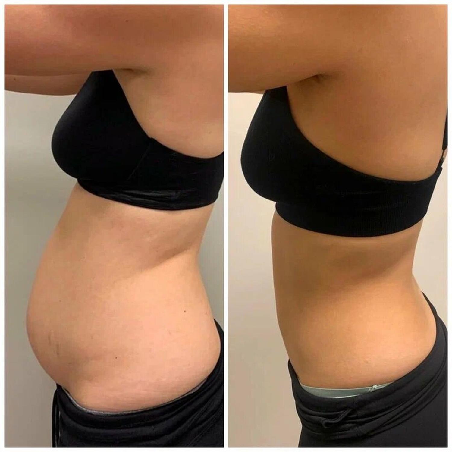 До и после Robolex: контур живота