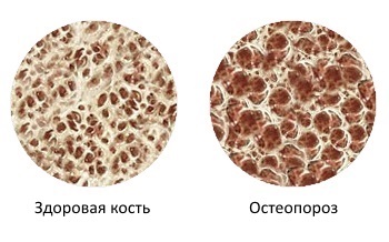 Конференция на тему «ОСТЕОПОРОЗ, ПАТОГЕНЕЗ, ДИАГНОСТИКА ЛЕЧЕНИЕ» Конференция на тему «ОСТЕОПОРОЗ, ПАТОГЕНЕЗ, ДИАГНОСТИКА ЛЕЧЕНИЕ»