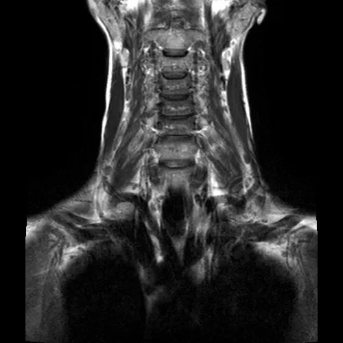 МРТ шейного отдела позвоночника